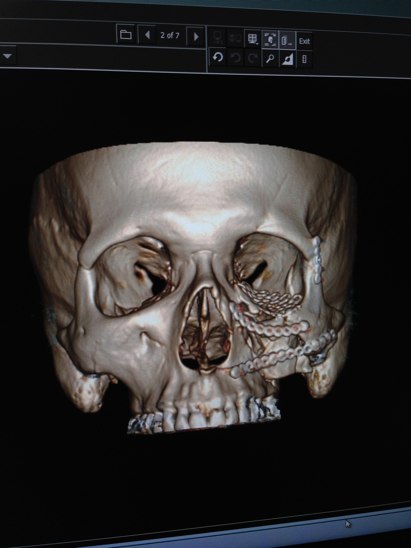 skull damage xray image