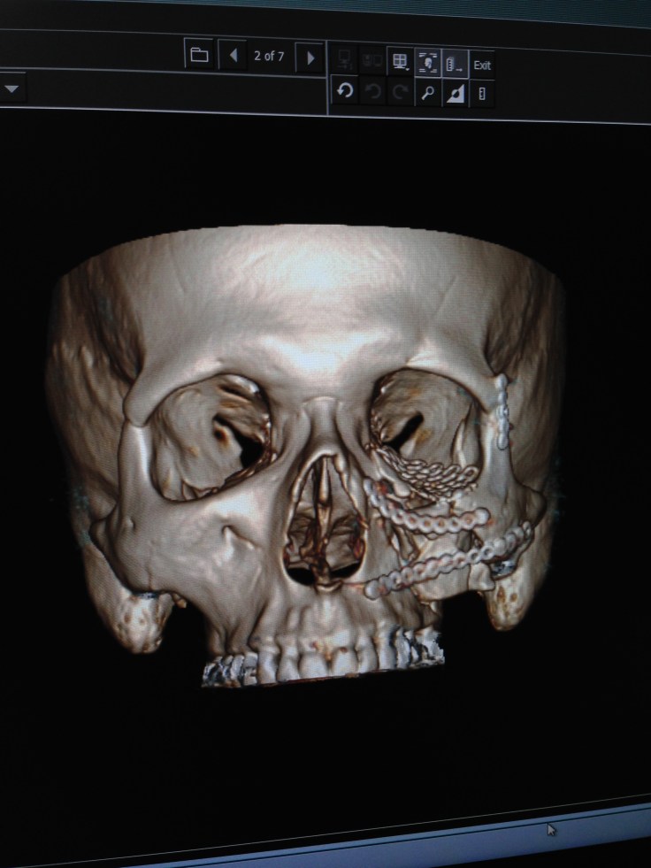 skull damage xray image