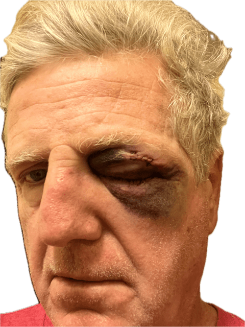 Mark face with after surf injury.